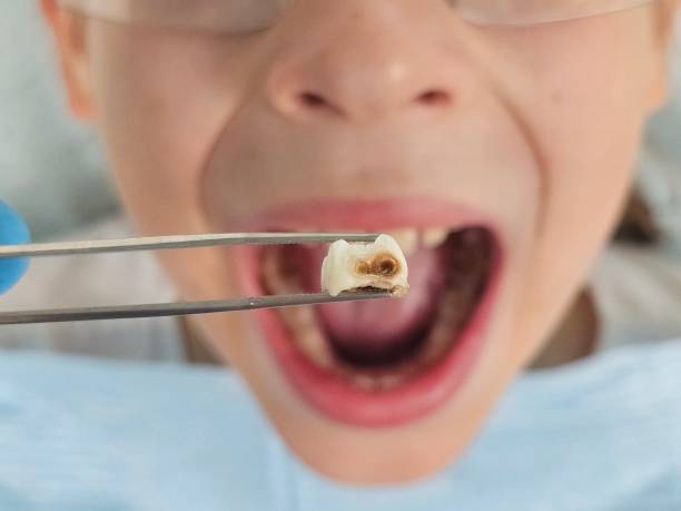 Best Chipped Tooth Repair Near Me  in Des C, AR